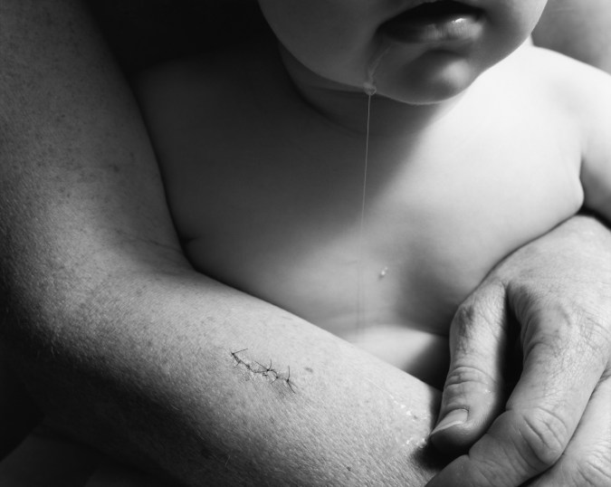 Black-and-white close-up photograph of a woman's arms with stitches holding a drooling toddler