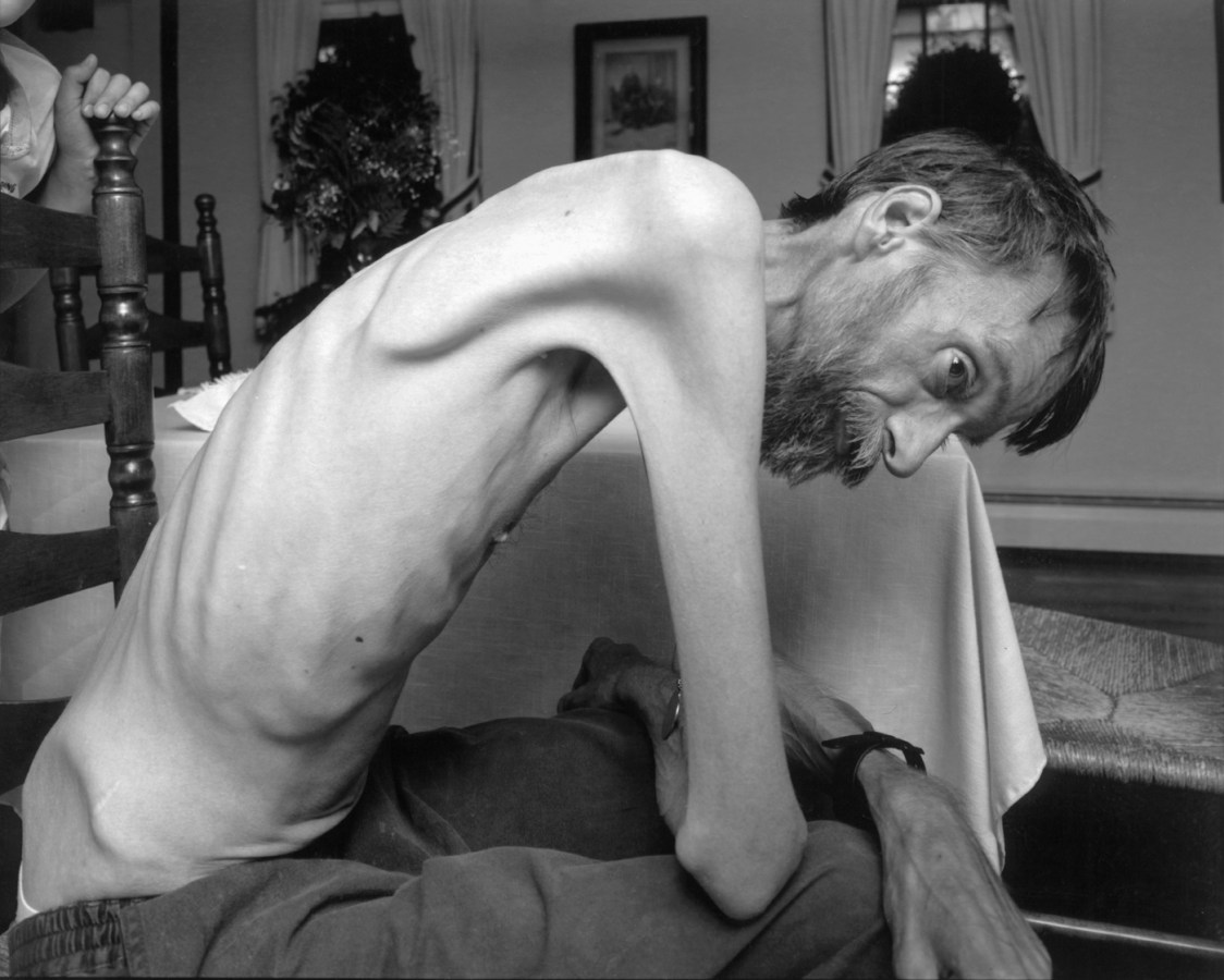 Black-and-white photograph of a seated emaciated man resting his forearms on his knees